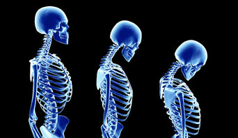 Scheuermann's Kyphosis
